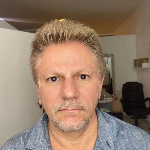 Depois — Harmonização Facial
